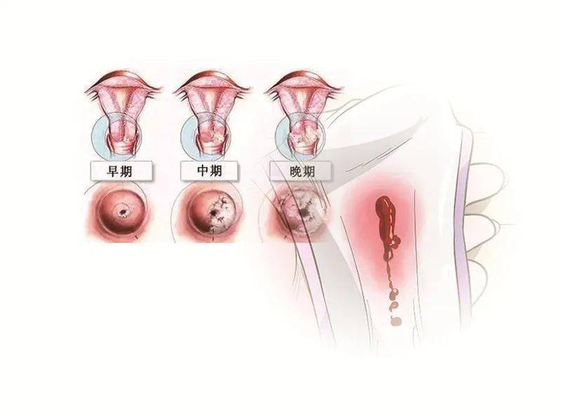 宫颈癌早期症状 女性图片