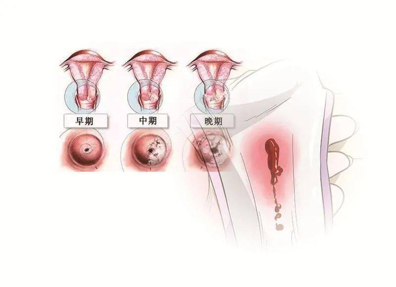 女性宫颈萎缩的图片图片