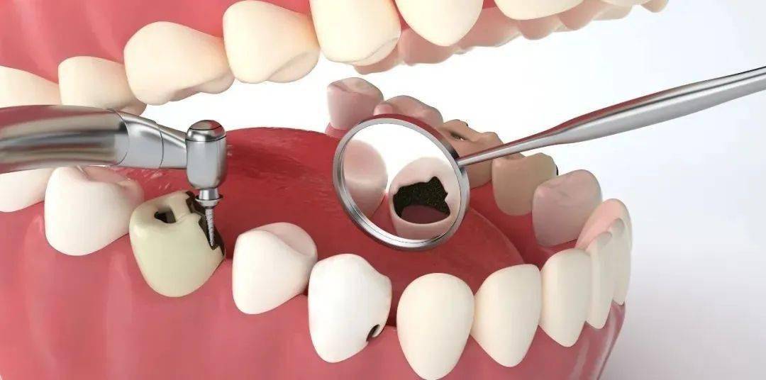 上火牙疼就用甲硝唑替硝唑吗