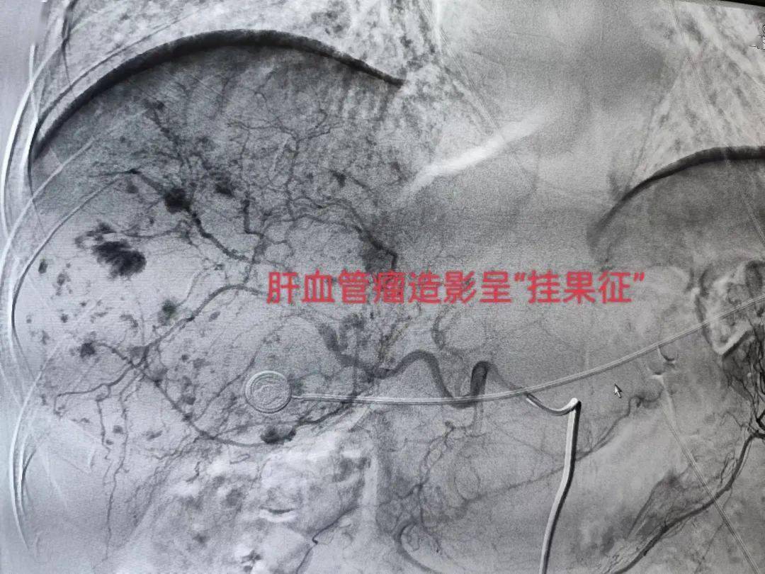 【医讯】广南县中医医院介入室30天完成介入手术量从0到100台_造影
