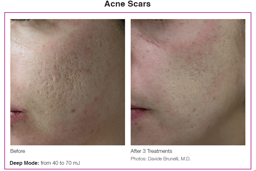 医美经典项目无可替代的二氧化碳点阵激光