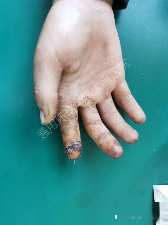 术后第3天手术的成功才是断指再植的第一步,断指再植患者需要严格卧床