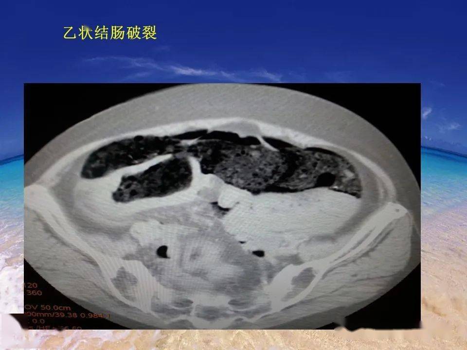 胃肠穿孔的ct图像图片