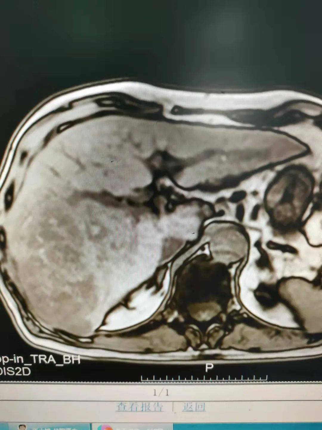 2021-04-18行上腹部增强磁共振检查提示:1,肝右叶肿瘤性病变,考虑肝癌