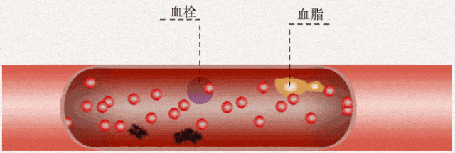 速度减慢,血管内皮损伤等也是致病因素,此外还有羊水栓塞,气体栓塞,非