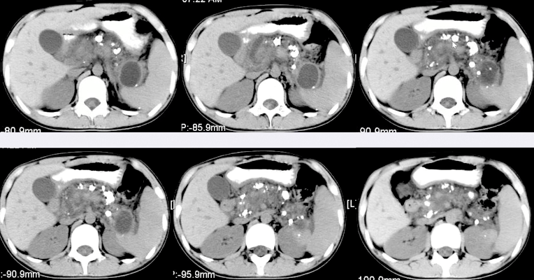 急性胰腺炎ct图片图片