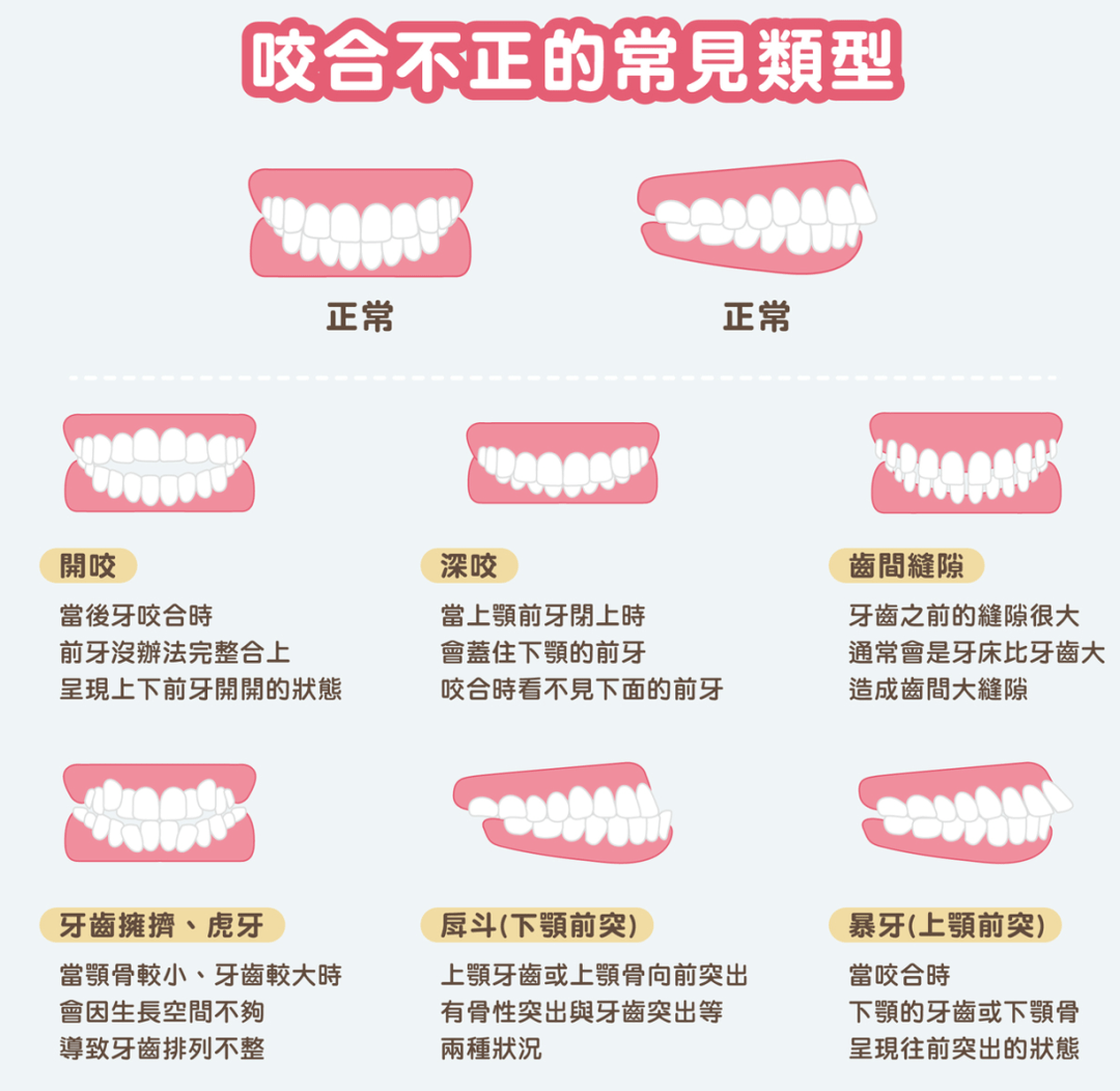 咬合不正的危害图片