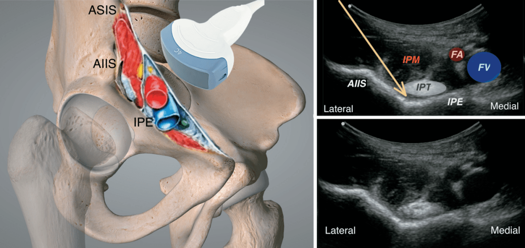 ipe:髂恥骨隆起;ipt:髂腰肌腱;ipm:髂腰肌;fa:股總動脈;fv:股總靜脈
