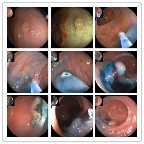 肠息肉早期图片图片