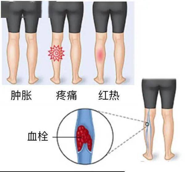 小腿血位置图片