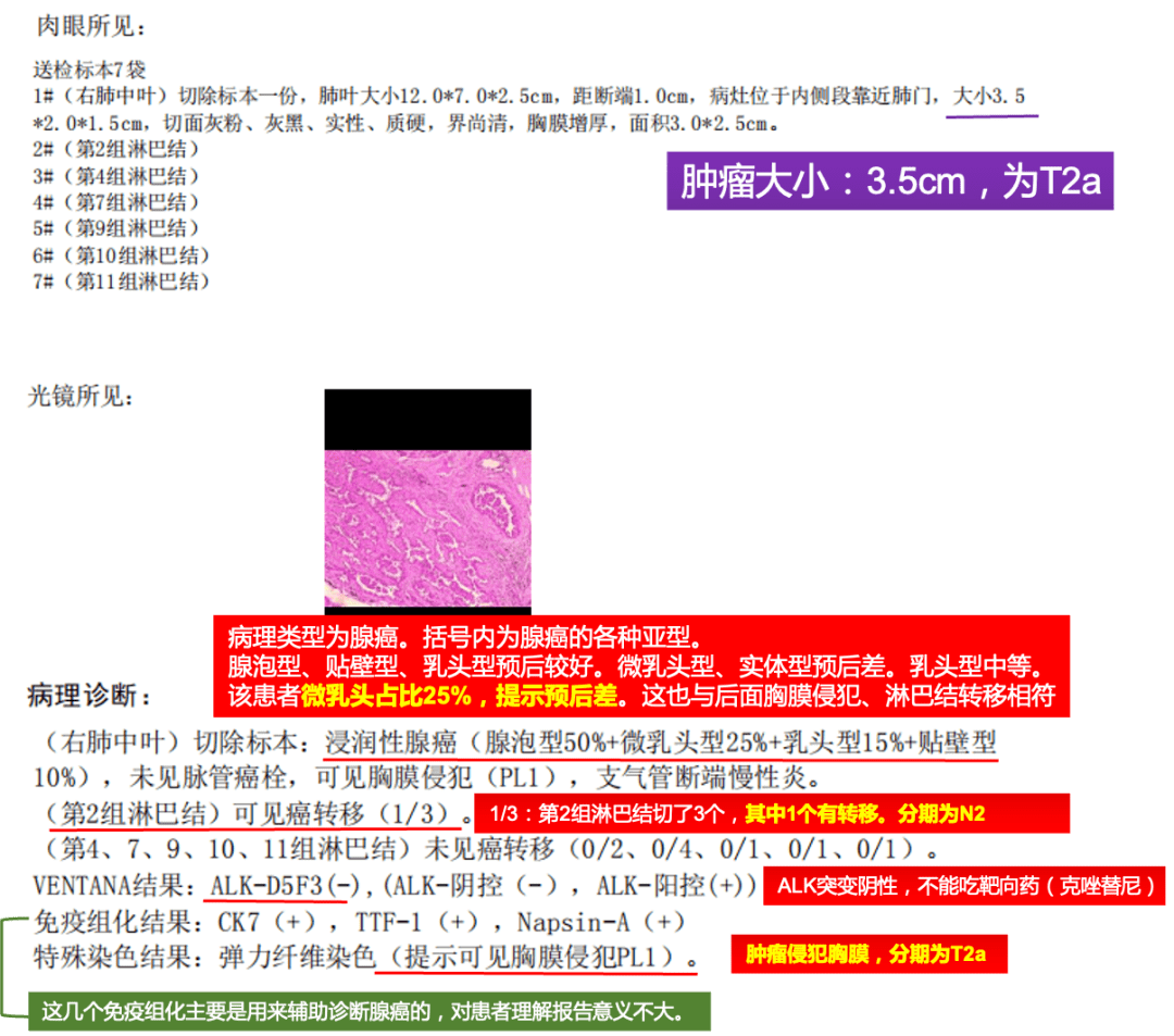 如何看懂肺癌【病理报告】?