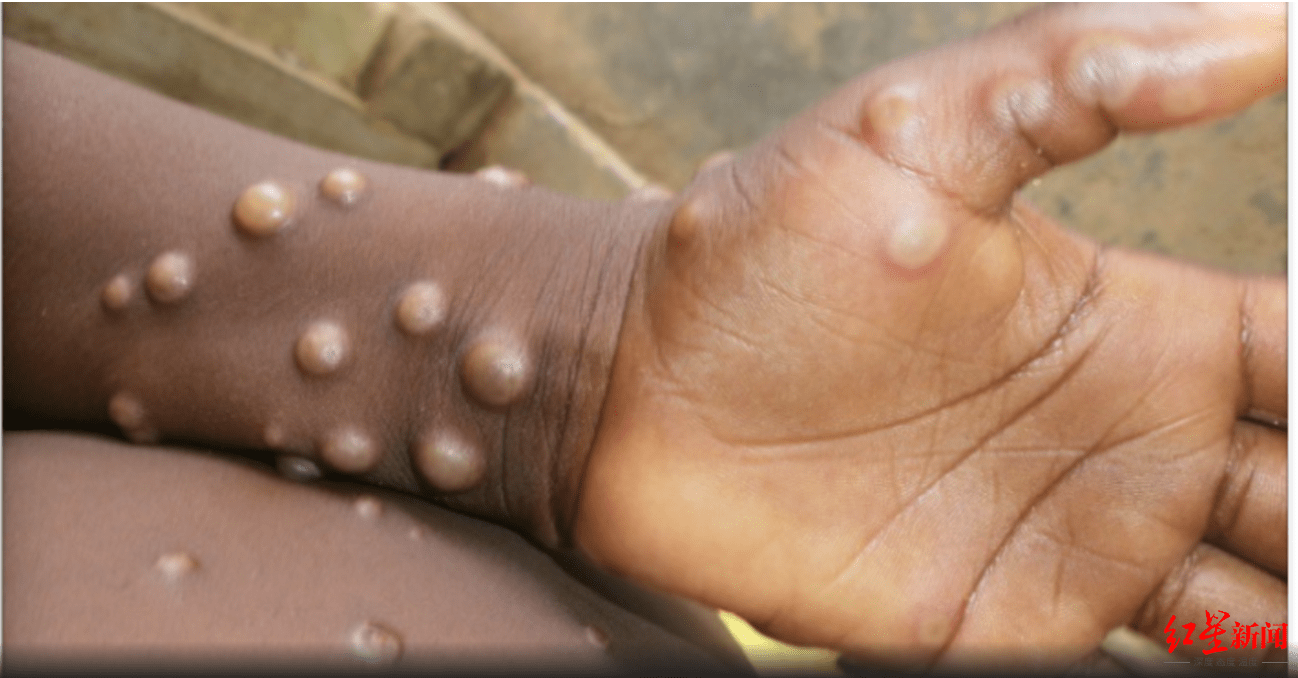 英国再现罕见"猴痘"病例,世卫组织:临床症状与天花相似,暂无针对性