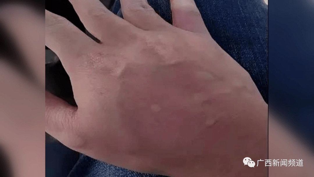 南宁市申记白蚁防治有限公司工作人员 申胜萍:立即用清水或者肥皂水