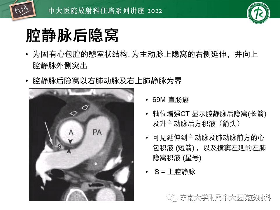 心包隐窝的ct解剖