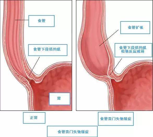 神经节细胞减少和变性导致其释放松弛食管括约肌的肠多肽和含氮氧化物