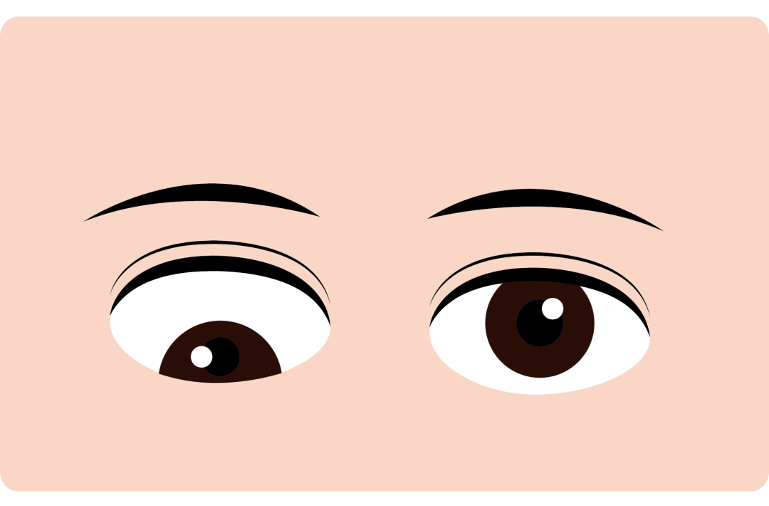 【科普】"斜视"知多少?_孩子_内斜视_治疗