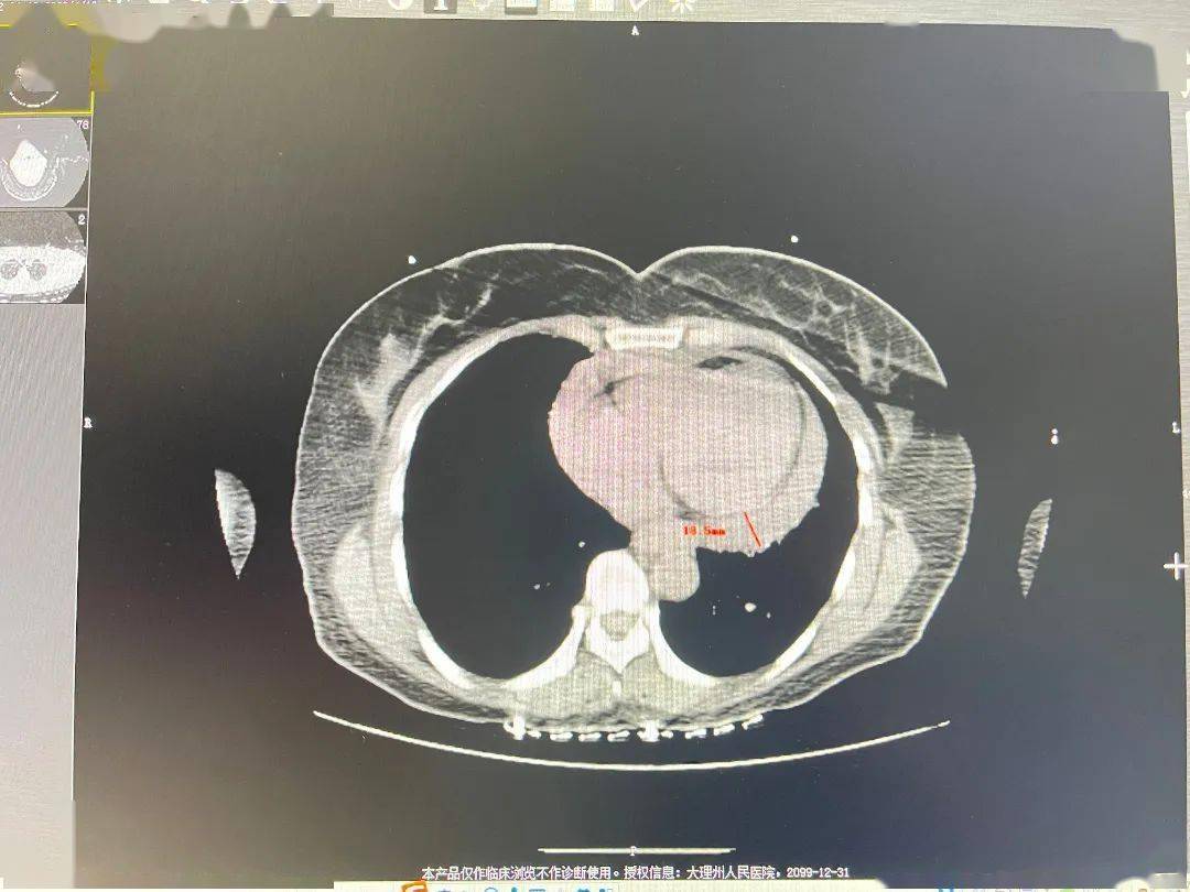 刺伤心脏,医生急救补心——凤仪分院创伤救治团队成功救治心脏刺伤