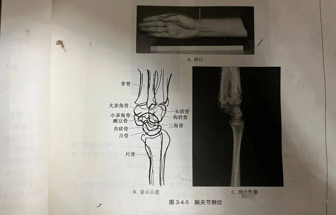 腕关节的读片技巧