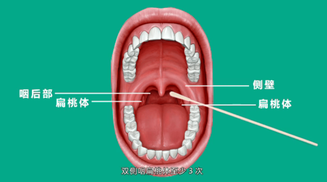 口咽后壁图片