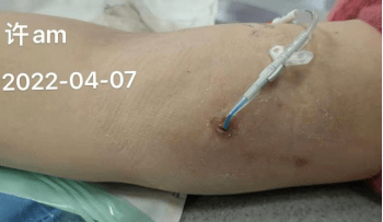 picc 并发金葡菌感染:导管一拔一留?这 2 个病例教训深刻!