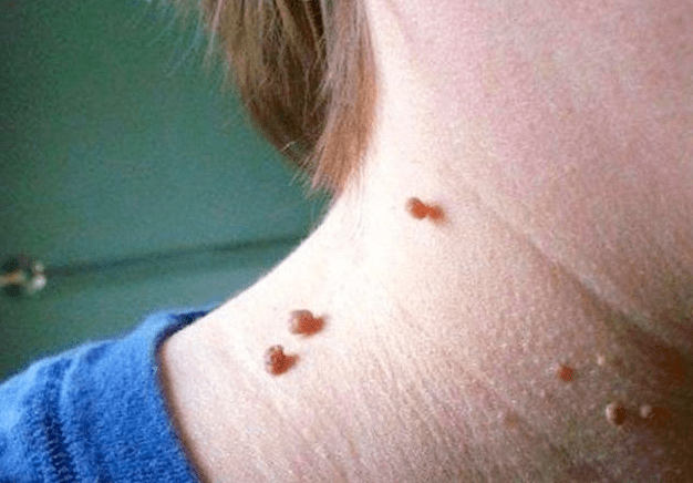 脖子上长小肉粒是怎么回事呢?