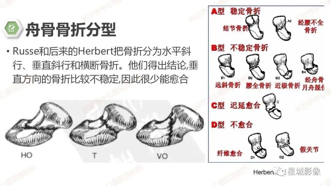 三角骨骨折三角骨骨折是僅次於舟骨骨折的最常見腕骨骨折.