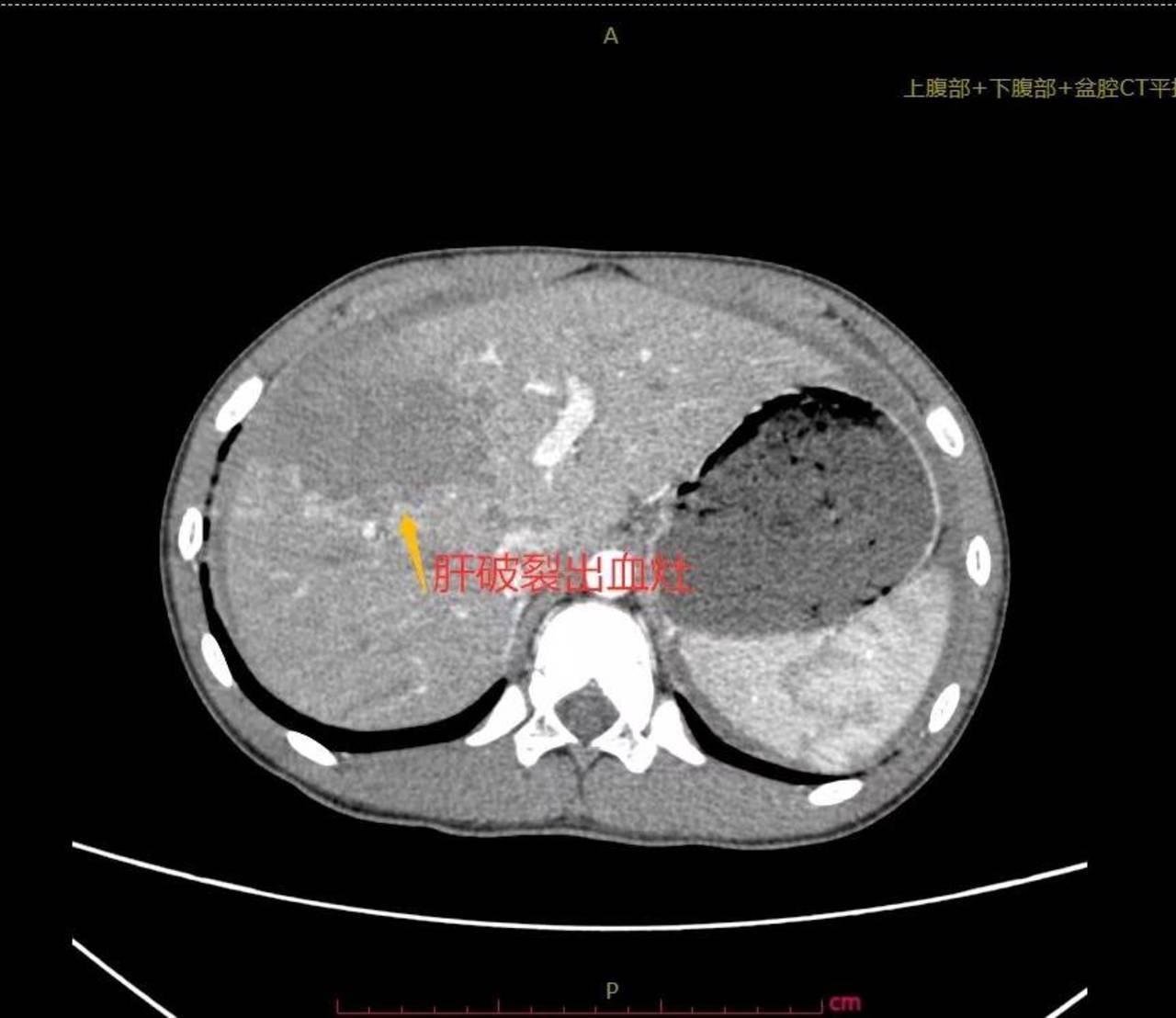 肝破裂ct图片