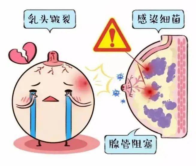 堵奶,乳腺发炎化脓……痛到想放弃哺乳的她们该怎么办