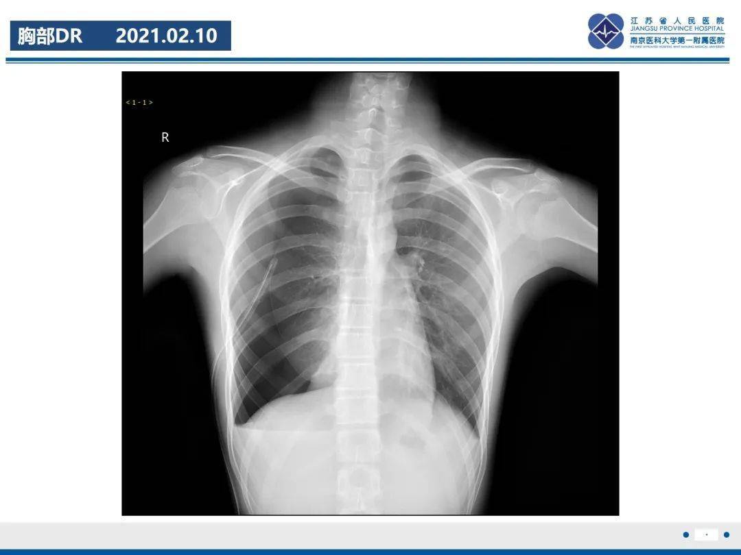 气胸X线图片