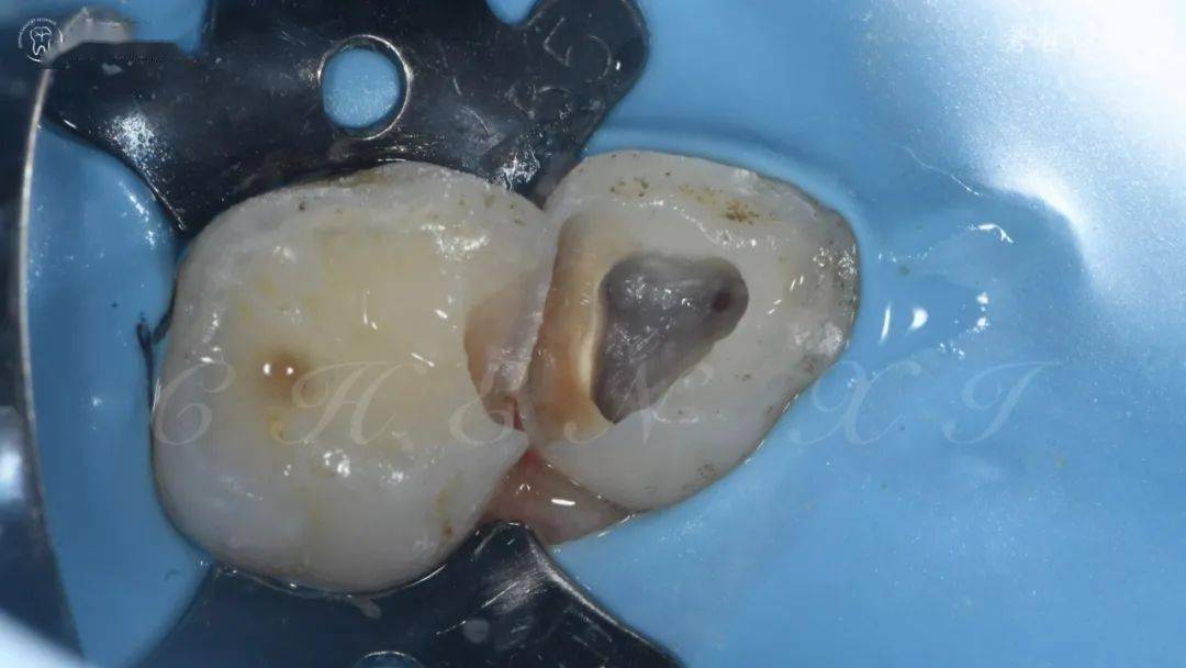 乳牙牙的根管开髓图图片