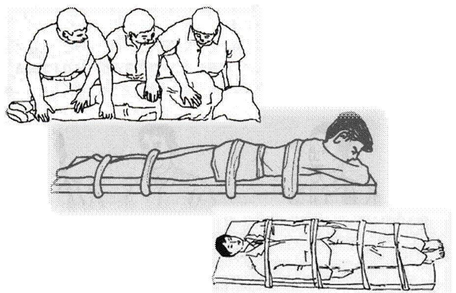 上肢固定下肢固定胸部固定四.断肢/指/趾的保存清水冲洗净.