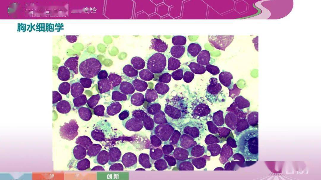 一例t淋巴母细胞白血病/淋巴瘤病例分享_检验_形态学_医学