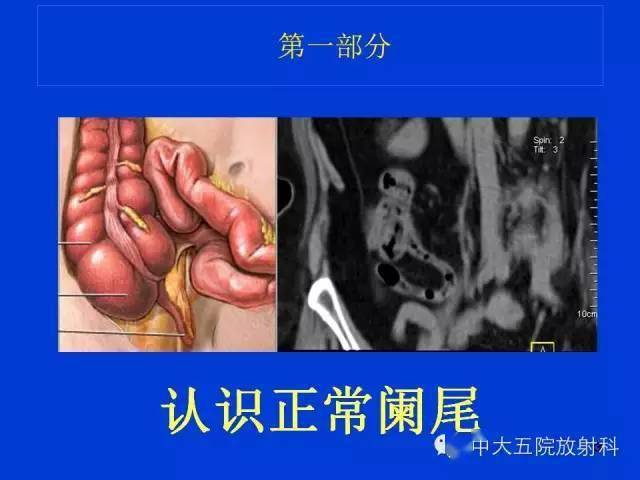 全面详解正常阑尾和阑尾炎的ct表现