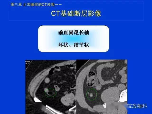 阑尾ct图解图像图片