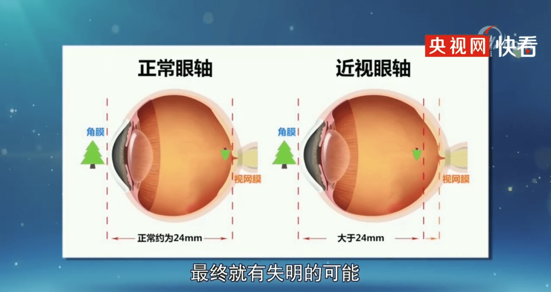 眼睛近视的原理是什么图片