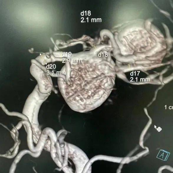 3d及數據測量:正側位造影:雙側ica c4-c6段管壁多