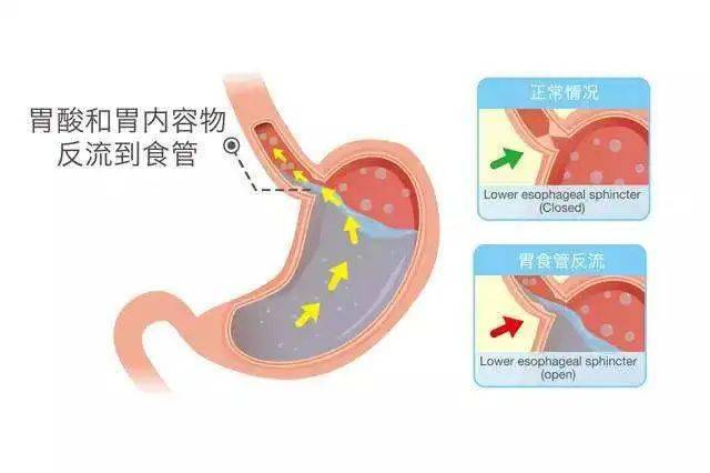 反流性胃炎该如何判断？