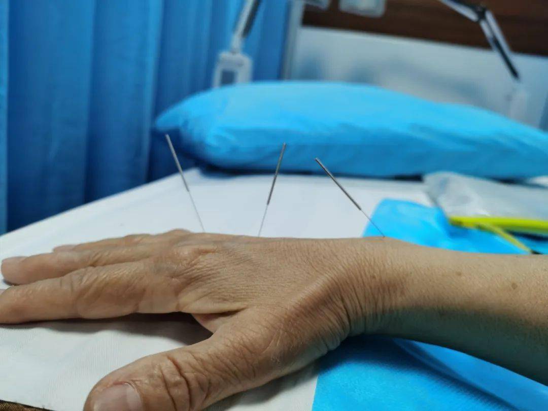 腿疼10年3针缓解针灸治疼痛太神奇