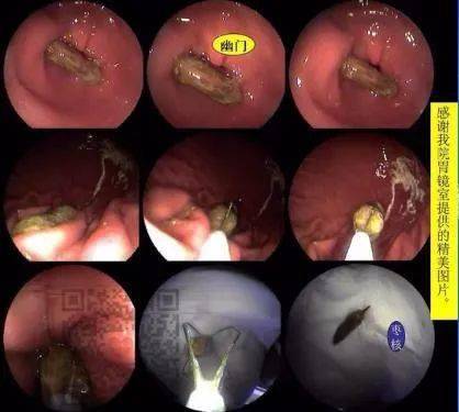 吞剑女吞胃镜图片