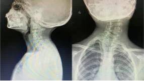 邵阳8岁男孩从小"喜欢"歪脖子,竟是患上这个先天性疾病_畸形_父母