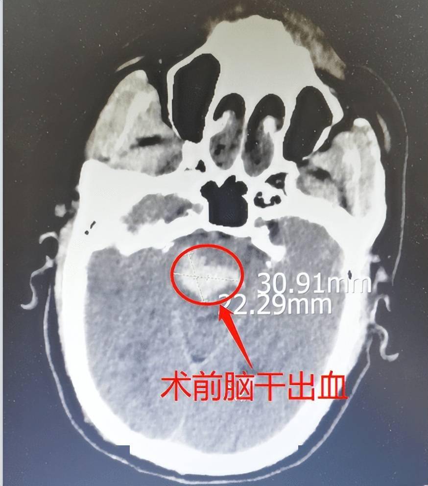 脑干出血命悬一线 神经外科医生勇闯"禁区"患者奇迹苏醒_贾栋_手术