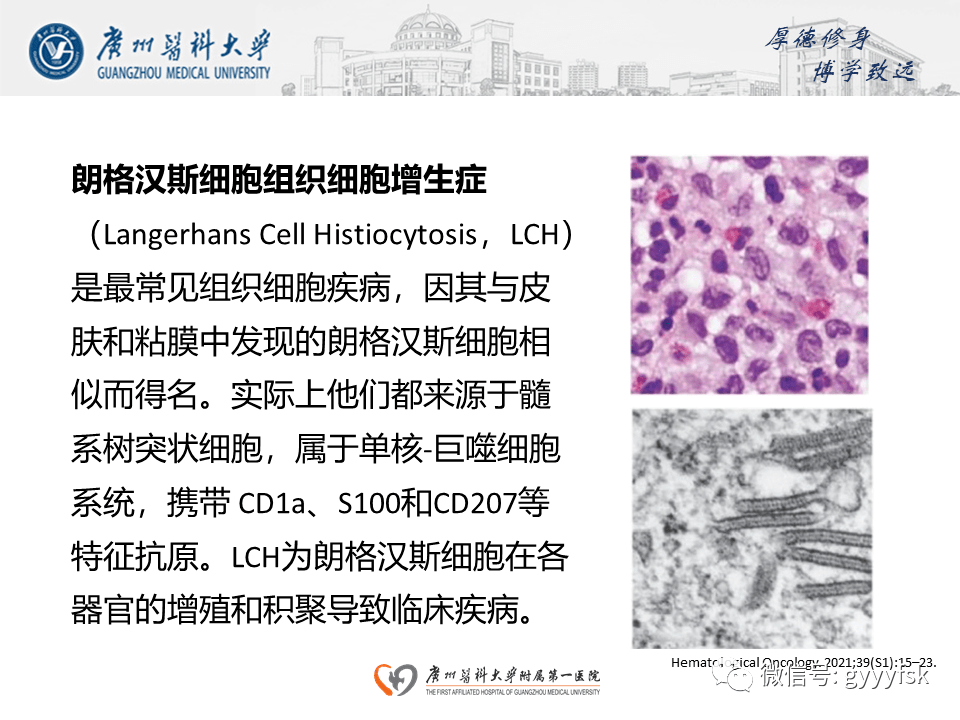详解朗格汉斯细胞组织细胞增生症系统性表现