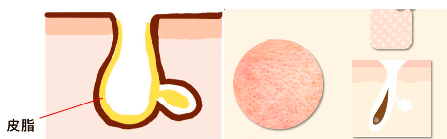 b二姐:张开型毛孔如果用力推出,它就会进化成开放的毛孔!