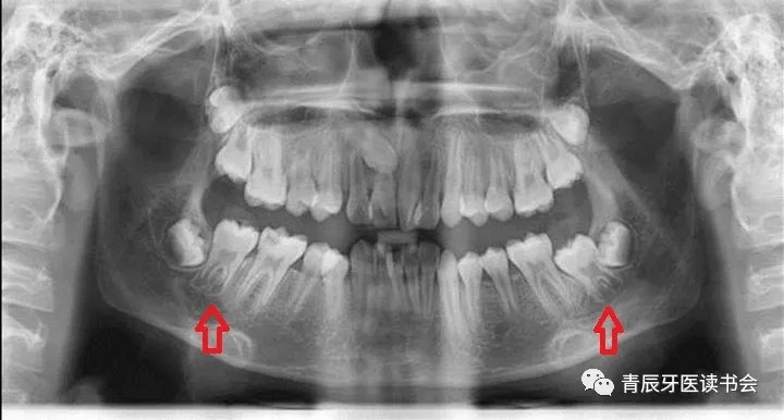 牛牙症的根管治疗