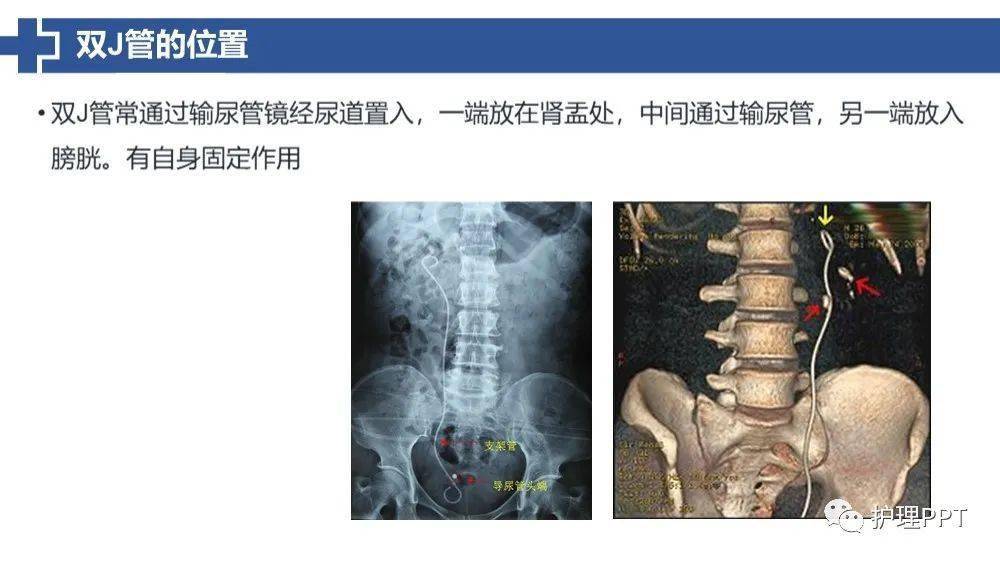 ppt双j管置入术后患者护理