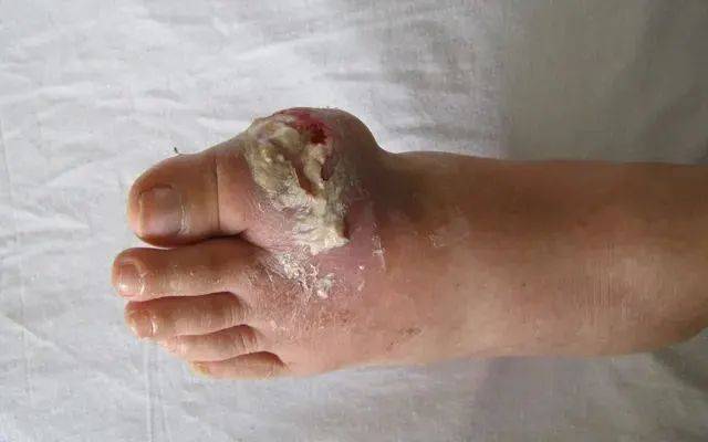 我21岁,不沾酒和海鲜,怎么就得痛风了?_尿酸_代谢_脚踝