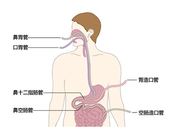 鼻饲管流程图图片