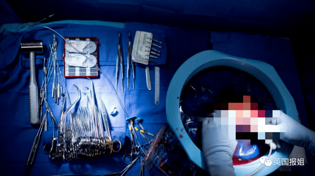 穷国器官贩卖黑市曝光明码标价心肺肾平民被诱骗囚禁开刀