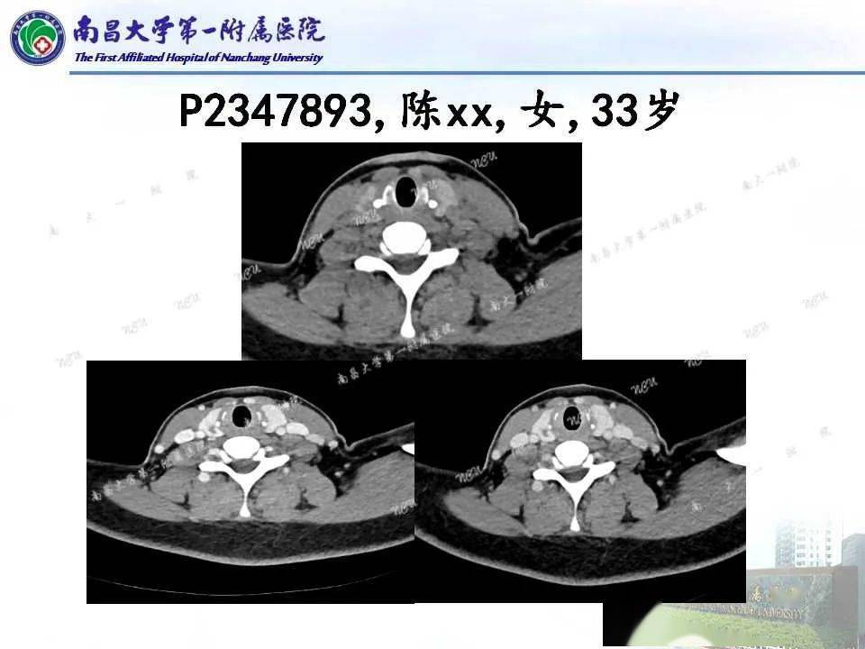 一文全面解析:常見甲狀腺結節的ct鑑別診斷_影像_陳燕_平臺