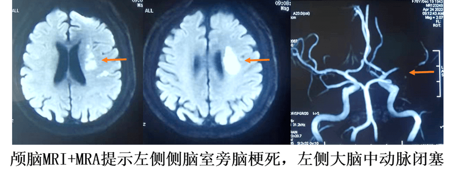 北京佑安医院神经内科为85岁患者实施大脑中动脉慢性闭塞开通术